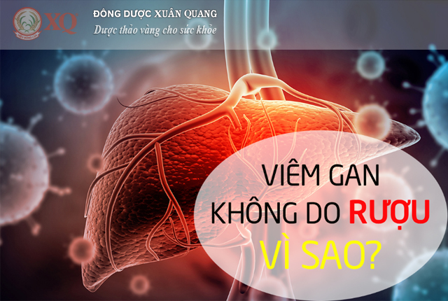Viêm gan không do rượu vì sao?