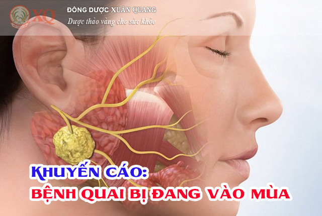 Khuyến cáo: bệnh quai bị đang vào mùa